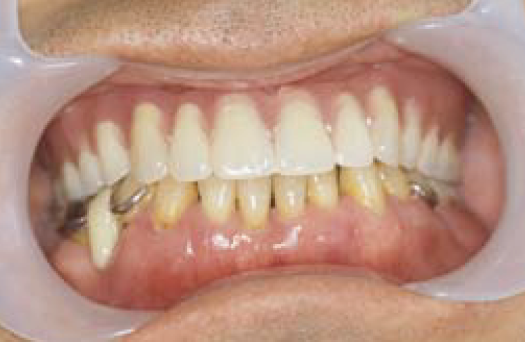 9. 磁石式義歯の完成