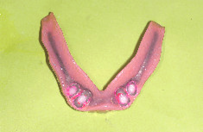 4.義歯製作