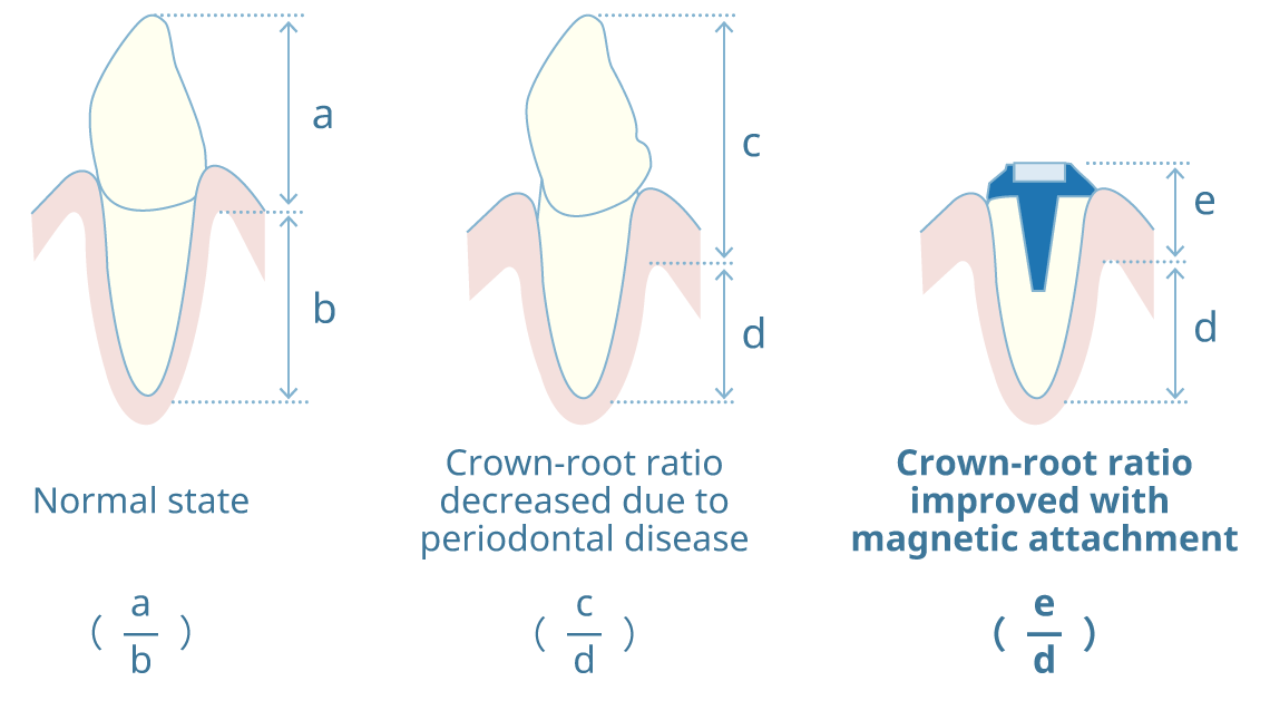improvement of crown root ratio of the abutment tooth
